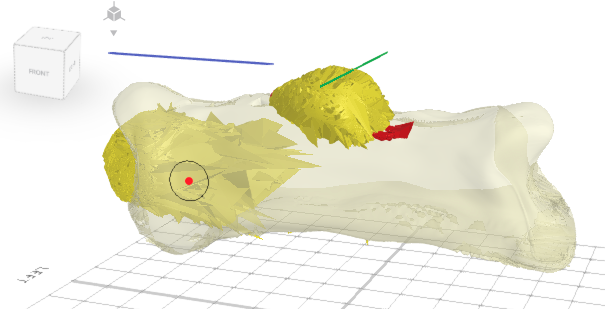 Modelado 3D de hueso con un patrón de crecimiento de osteosarcoma