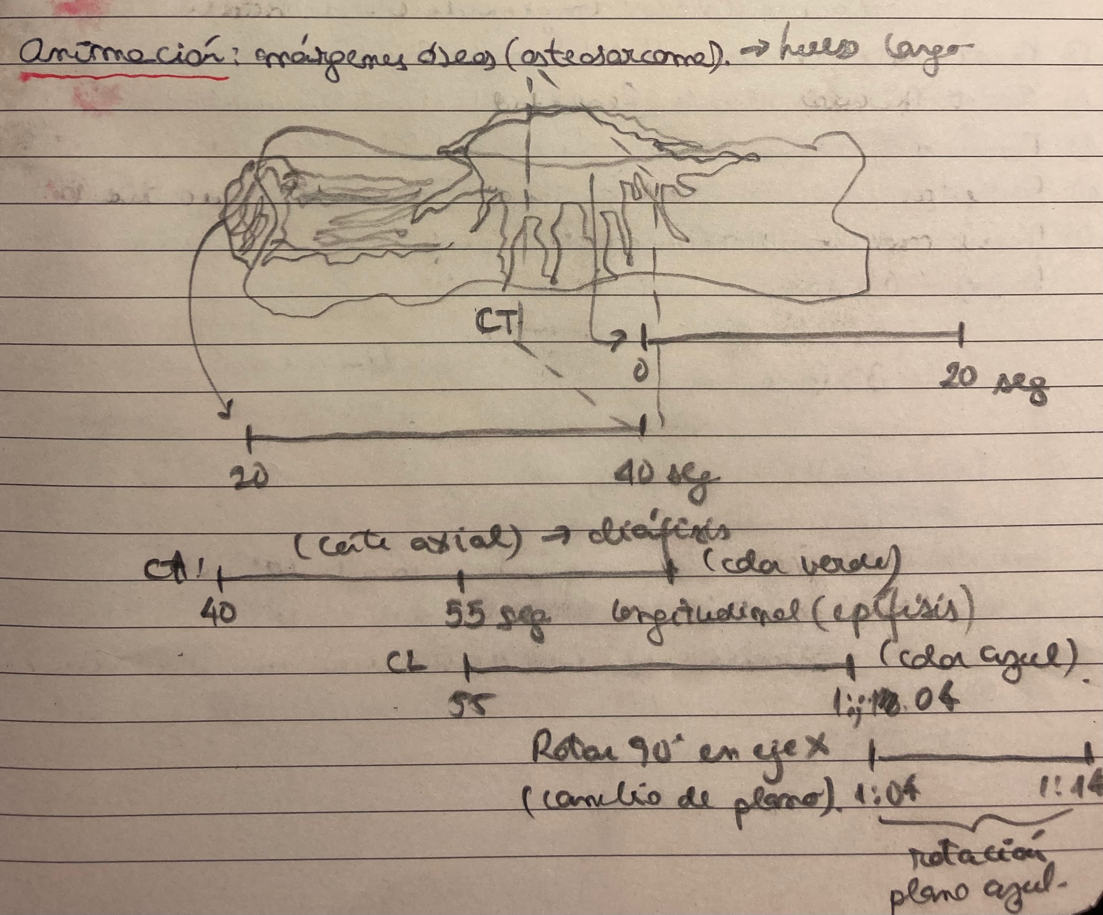 Boceto modelo 3D del patrón de crecimiento de osteosarcoma de hueso largo con dos conos de origen